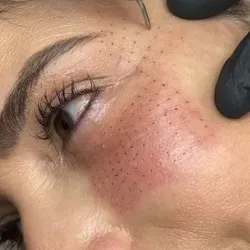 Fibroblast Facial