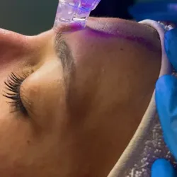 Limpieza Facial Profunda con Hidrodermoabrasión y Crioterapia Activa.