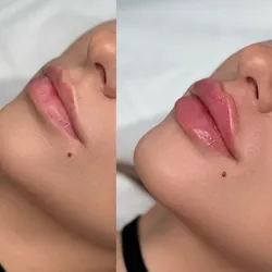 Labios. Filler Lips   Ácido Hialurónico