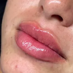 Labios. Filler Lips Ácido Hialurónico