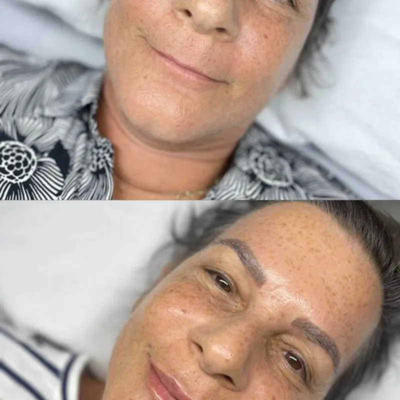 Labios. Rellenos con Ácido Hialurónico