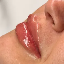 Labios. Filler Lips Ácido Hialurónico
