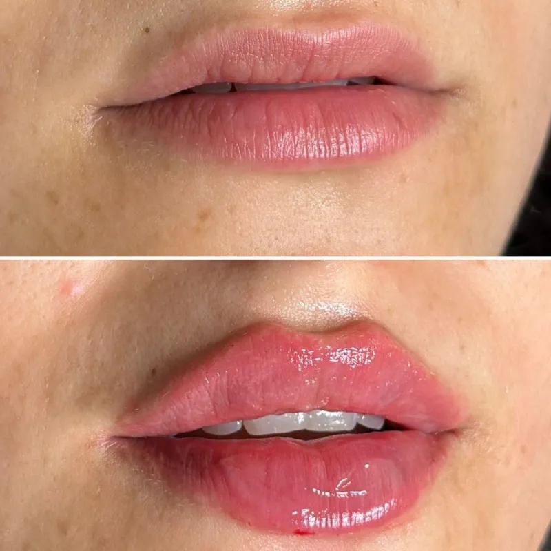 Labios. Filler Lips   Ácido Hialurónico