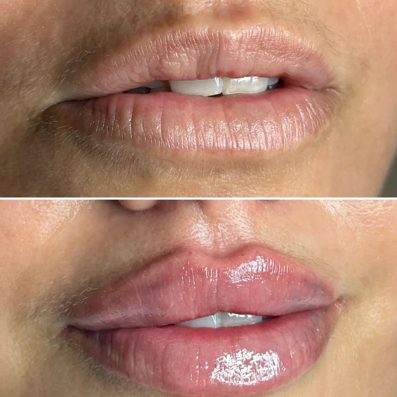 Labios. Filler Lips   Ácido Hialurónico
