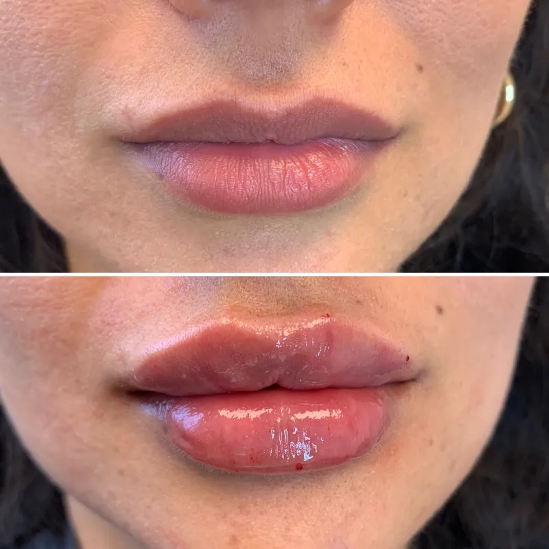 Labios. Rellenos con Ácido Hialurónico