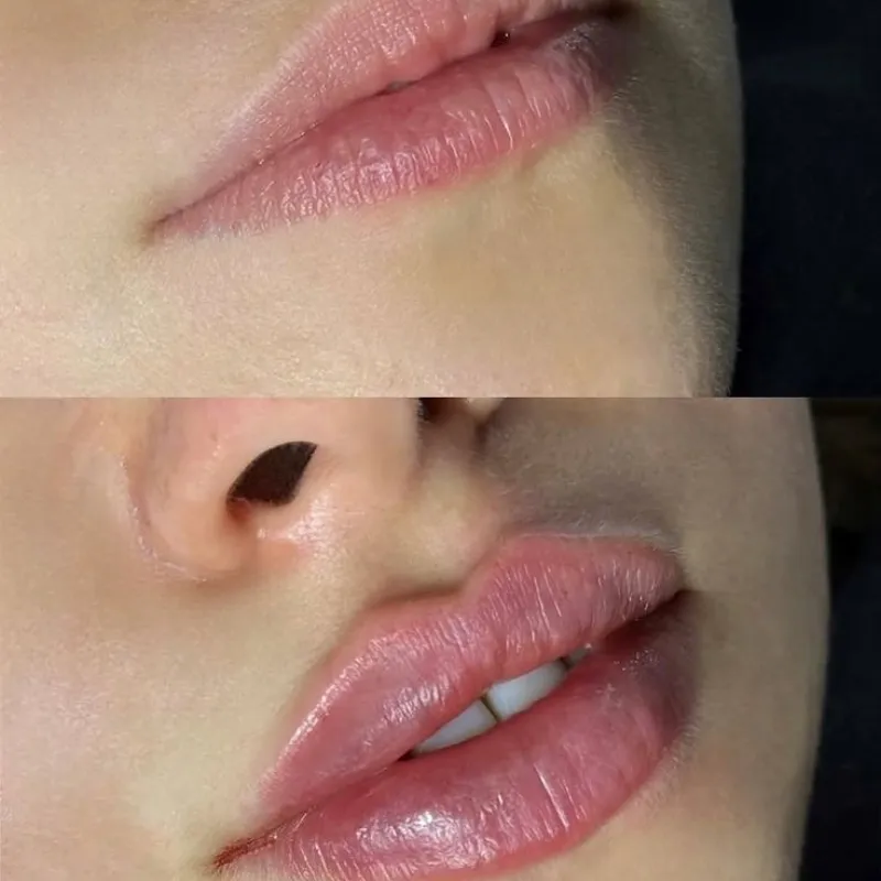 Labios. Rellenos con Ácido Hialurónico