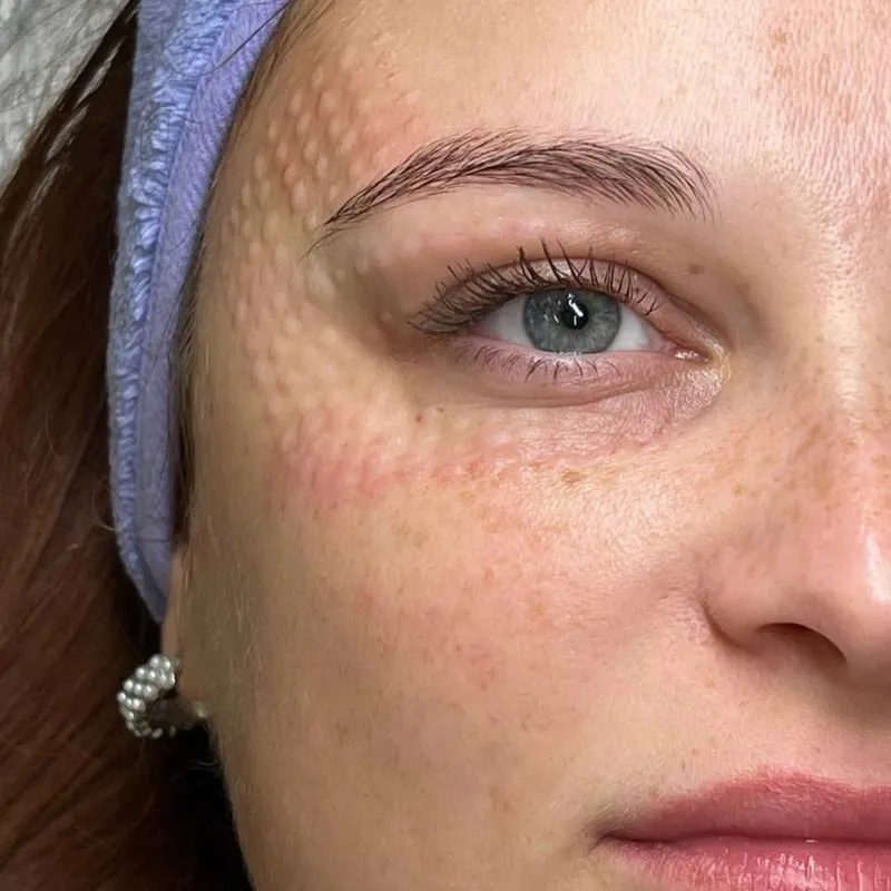 ADN de Salmón PDRN. Regeneración celular avanzada