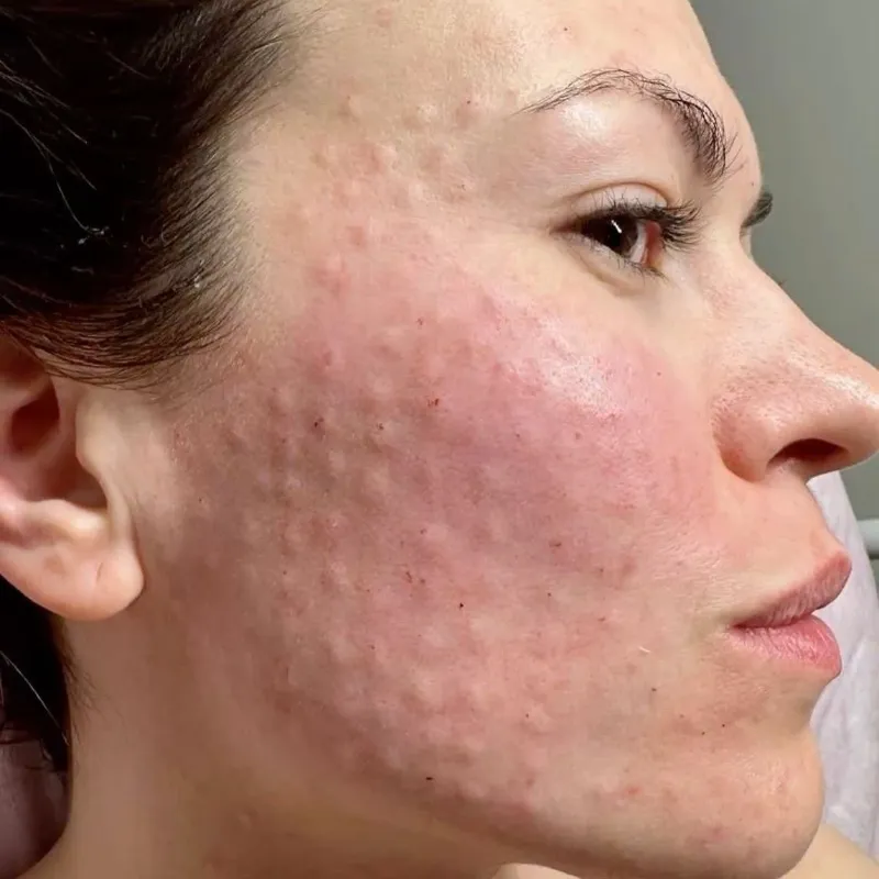 ADN de Salmón PDRN. Regeneración celular avanzada