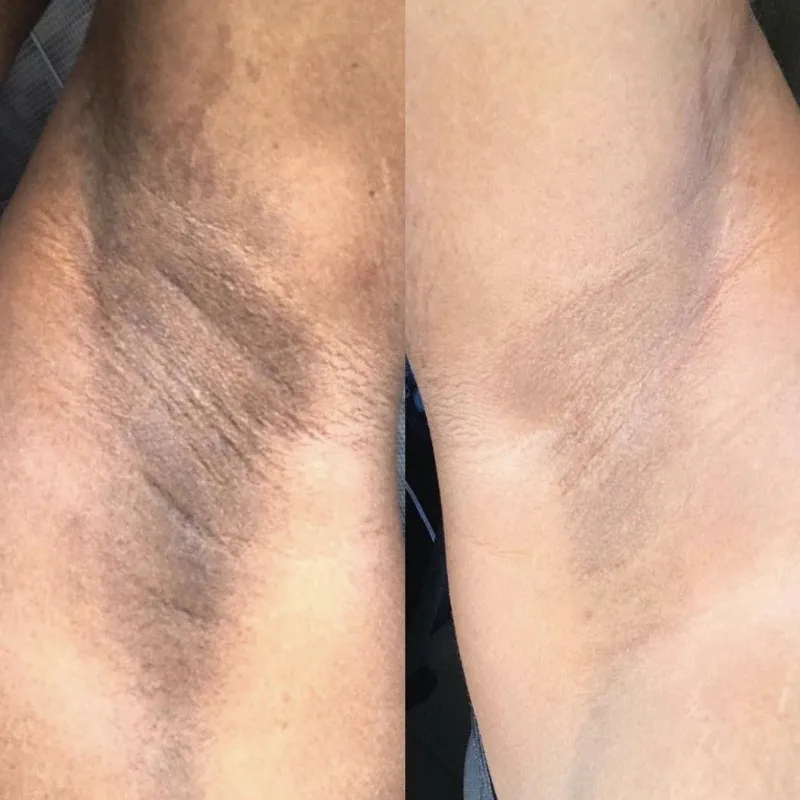 Blanqueamiento de Regiones Corporales