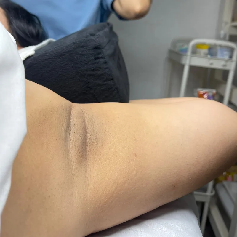 Blanqueamiento de Regiones Corporales