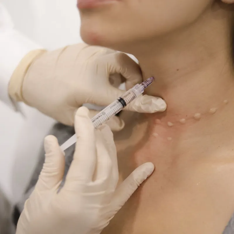 Cuello y escote micro, inyecciones con ADN de salmón.