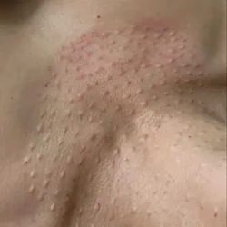 Cuello y escote micro, inyecciones con ADN de salmón. 