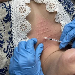 Cuello y escote micro, inyecciones con ADN de salmón. 