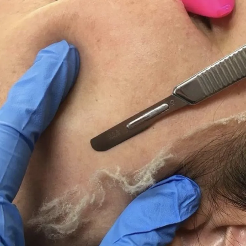 Dermaplaning 