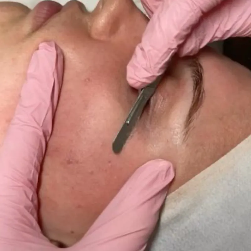 Dermaplaning 