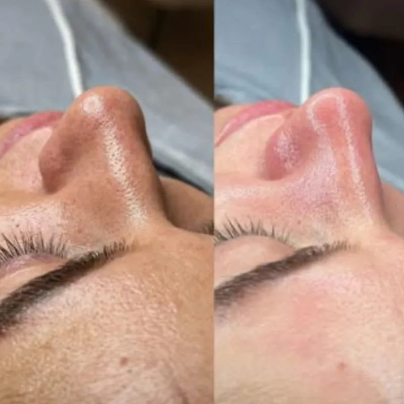 Dermaplaning 