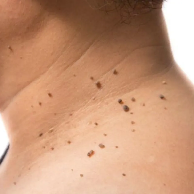 Eliminación de verrugas 