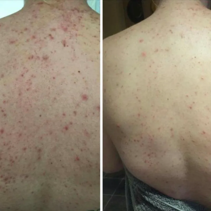 Limpieza Profunda de Espalda