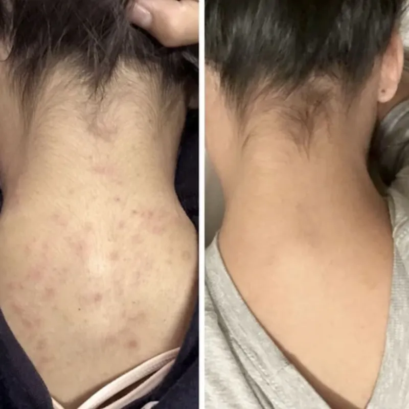 Limpieza Profunda de Espalda