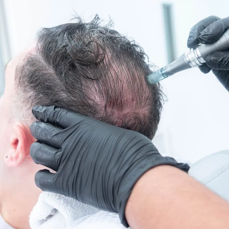 Microneedling Capilar