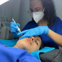 Microneedling con dermapen 
