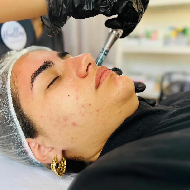Microneedling con Dermapen