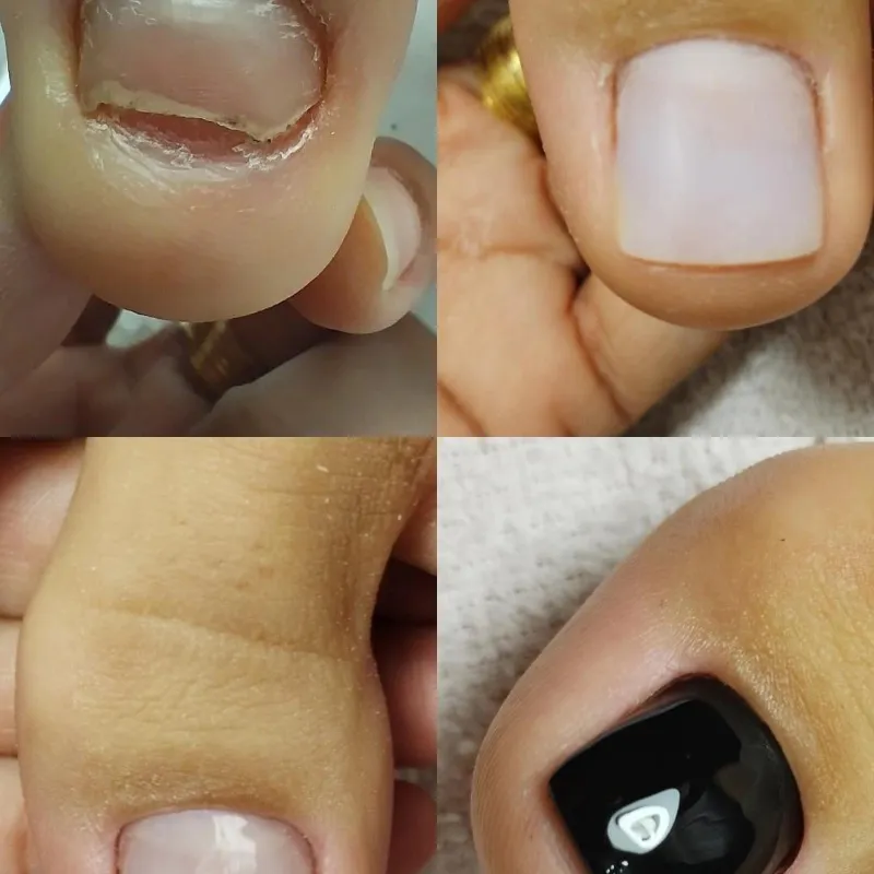 Reconstrucción de uñas