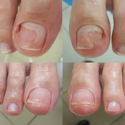 Reconstrucción de uñas