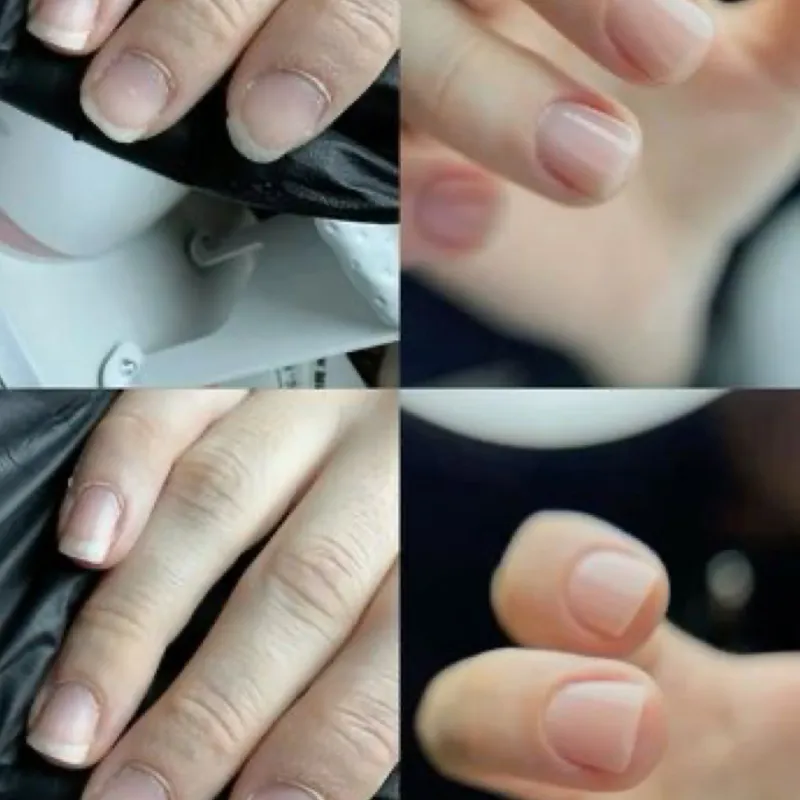 Reconstrucción de uñas