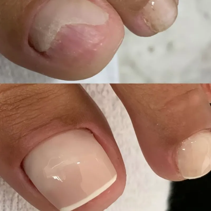 Reconstrucción de uñas