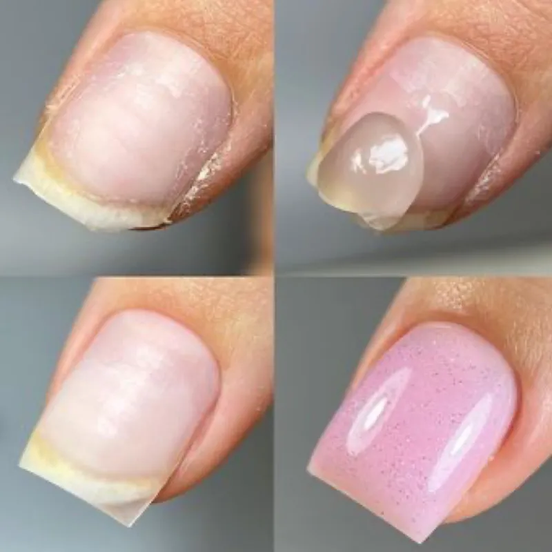 Reconstrucción de uñas