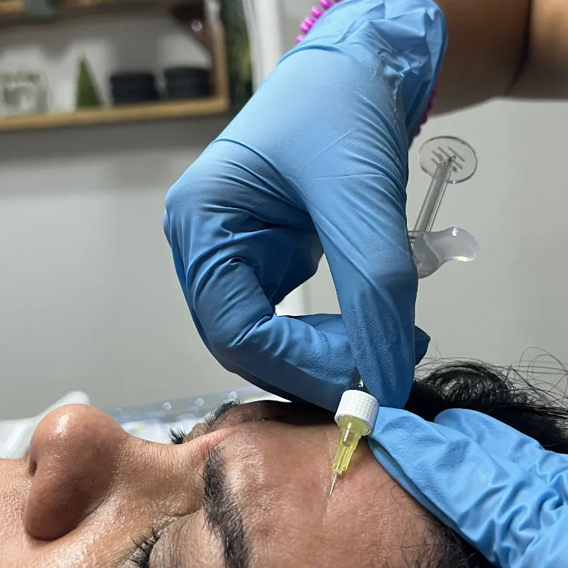 Relleno de Arrugas y Surcos Con ácido Hialurónico