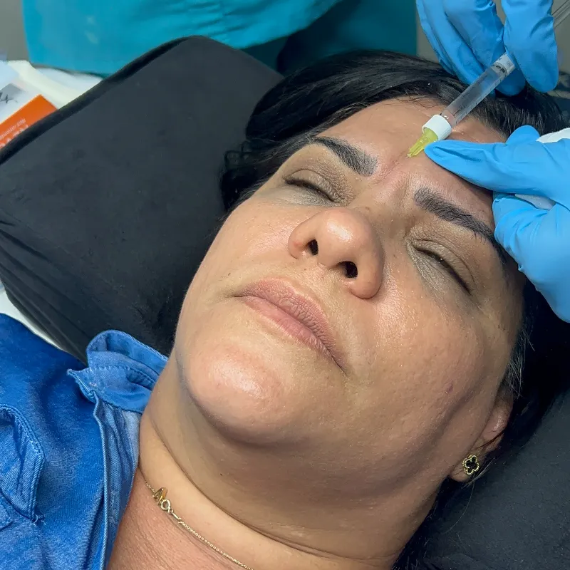 Relleno de Arrugas y Surcos Con ácido Hialurónico