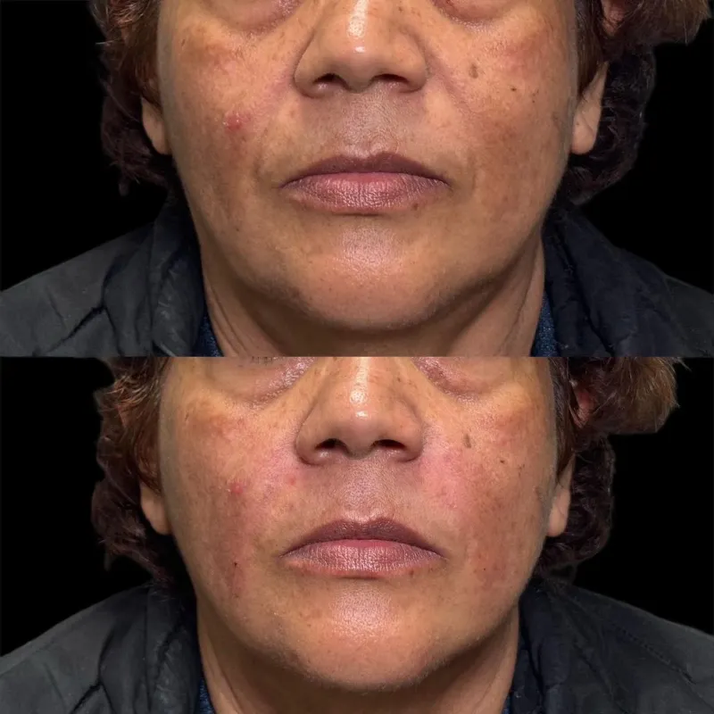 Relleno de Arrugas y Surcos Con ácido Hialurónico