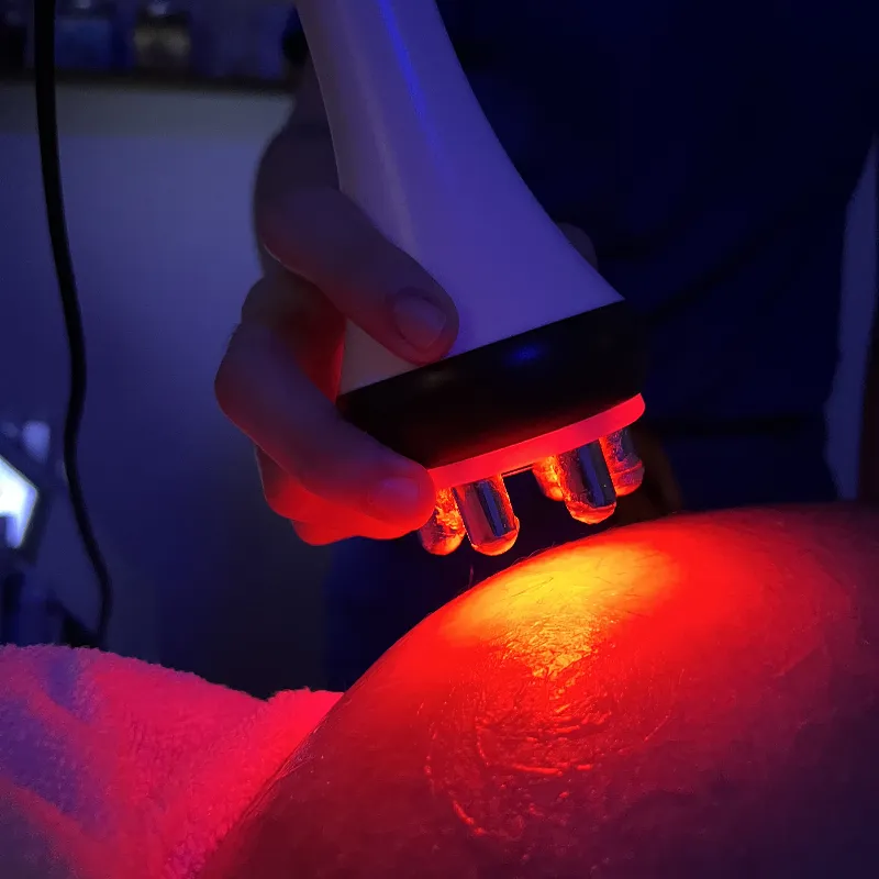 Tratamiento Estrías (mejorar apariencia)