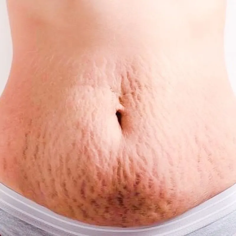 Tratamiento Estrías (mejorar apariencia)