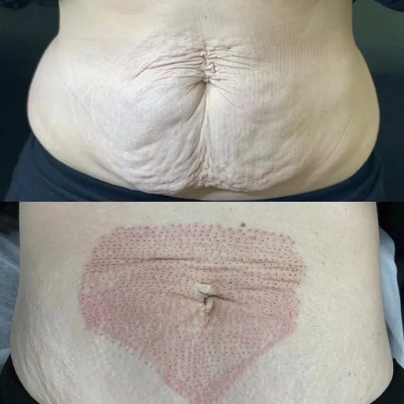 Tratamiento Estrías (mejorar apariencia)