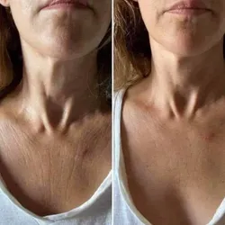 Tratamiento para Cuello y Escote