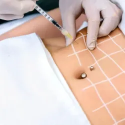 Tratamiento quemador de Grasa localizada