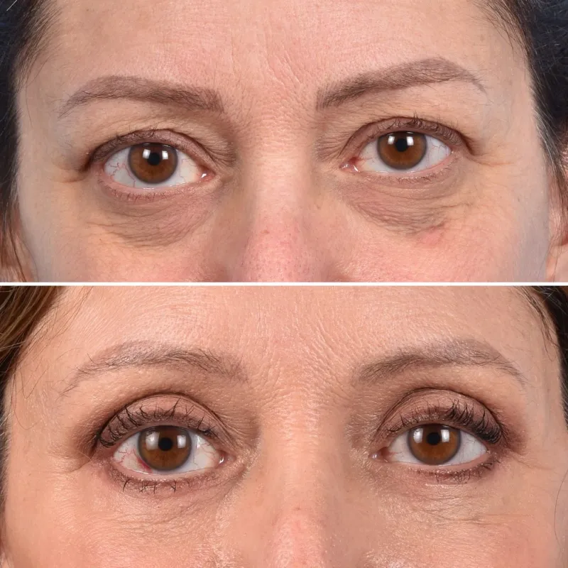 Ojeras y contorno de Ojos. Renovador. Ami Eyes