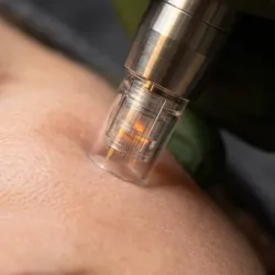 Biorevitalización de la piel mediante microneedling
