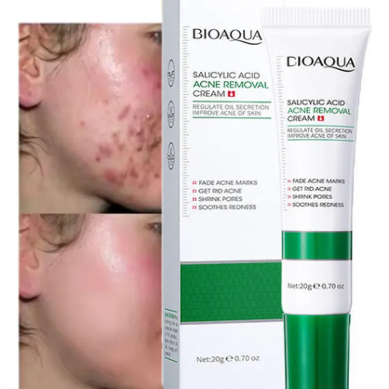 Crema Anti Acné de Ácido Salicílico BIOAQUA