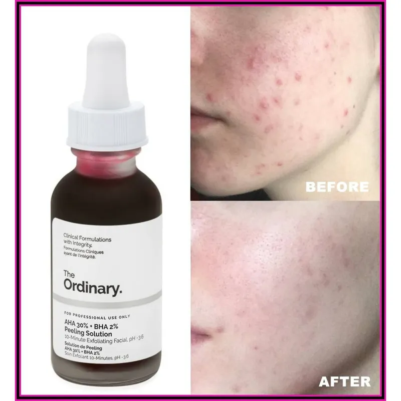 Peeling Solution.AHA 30% + BHA 2% The Ordinary (30ml)