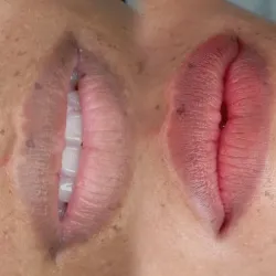 Pigmentación de labios 