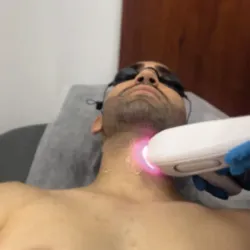 Depilación Láser Hombres 