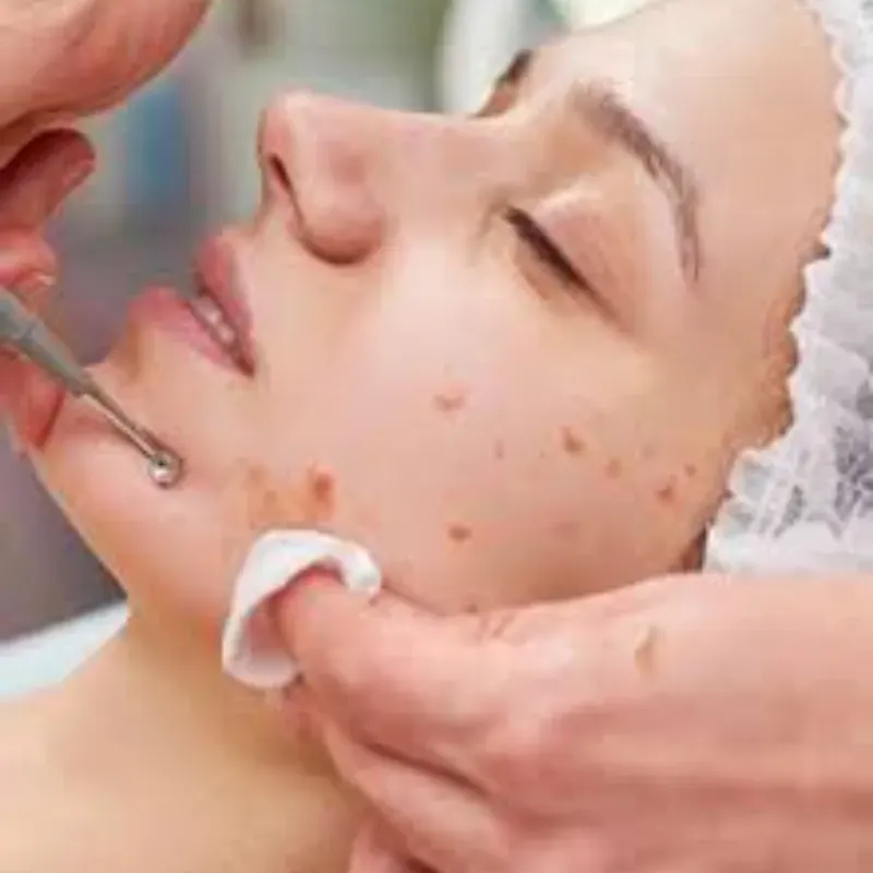Facial Acné 