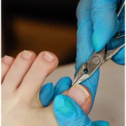 Corte y limado de uña encarnada 