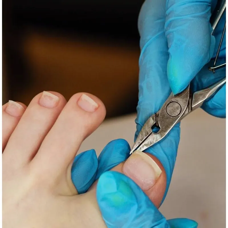 Corte y limado de uña encarnada 