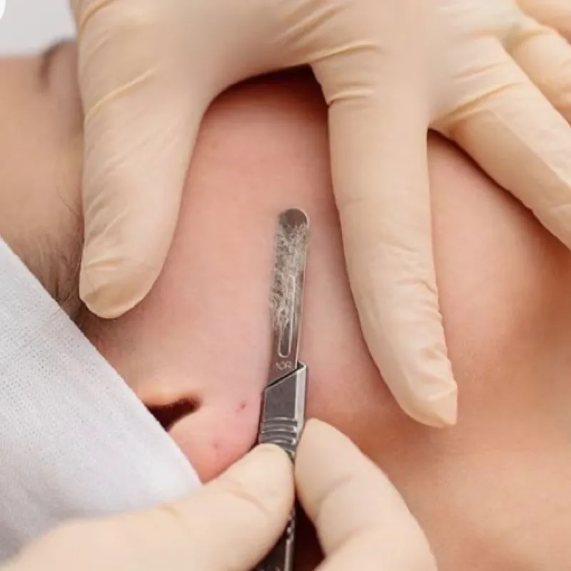 Facial con Dermaplaning