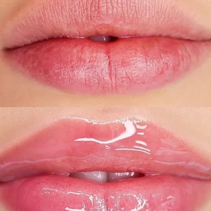 Hydralips con dermapen 